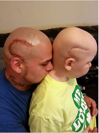 息子のために ここまでできる 頭に手術痕のタトゥーをいれた父親