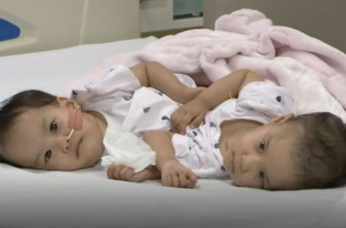 結合双生児の姉妹の手術が無事成功