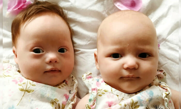 1人だけダウン症を持って生まれた 100万分の1 の双子