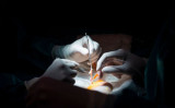腎臓移植の準備をする医師たち。参考写真（Pierre-Philippe Marcou/AFP/Getty Images）