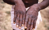 1997年にコンゴ民主共和国でサル痘ウイルスに感染した患者の手 （米国疾病予防管理センター）