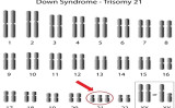 ダウン症の人は、21番染色体のコピーを3本持っている （Shutterstock）