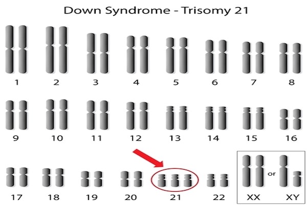ダウン症の人は、21番染色体のコピーを3本持っている （Shutterstock）